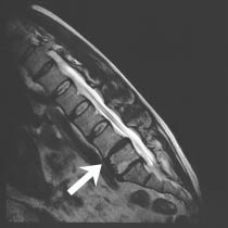 Flexion MRI