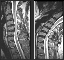 Herniation_cs_2