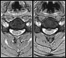 Herniation_cs_3