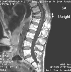 Kyphosis-6A MRI