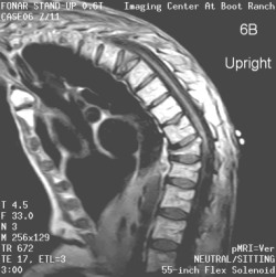 Kyphosis-6B MRI