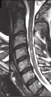 Neutral MRI of postraumatic transient spinal cord injury