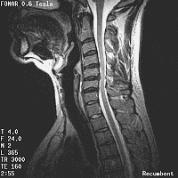 Upright Dynamic MRI Reveals Occult Disc Herniation Occult_frame6_200