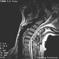 Upright Dynamic MRI Reveals Occult Disc Herniation Occult_no3_cerv_sag_stex200