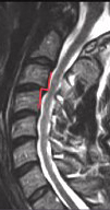 + Parasagittal MRI of postraumatic transient spinal cord injury