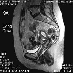 BLADDER AND UTERINE PROLAPSE_9a