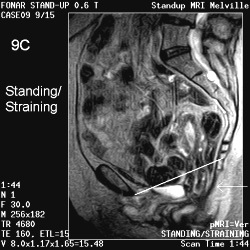 BLADDER AND UTERINE PROLAPSE 9c