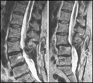 Severe Spondylolisthesis Undetected by Recumbent MRI img