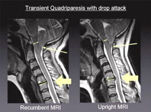 Transient Quadriparesis with drop attack MRI