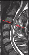 Upright Extension MRI of postraumatic transient spinal cord injury