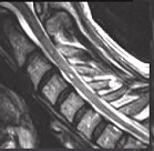 Upright - Flexion MRI