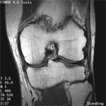 Upright MRI scanning the knee